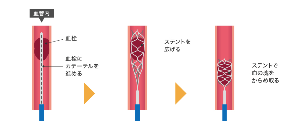 ステント型