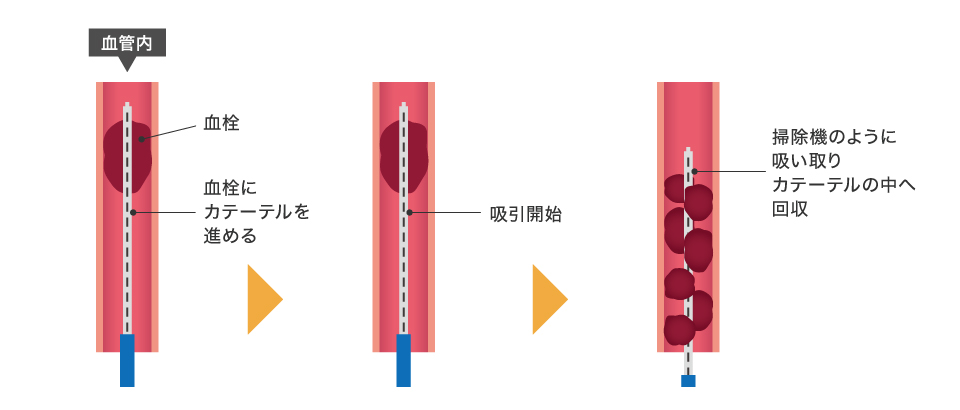 吸引型