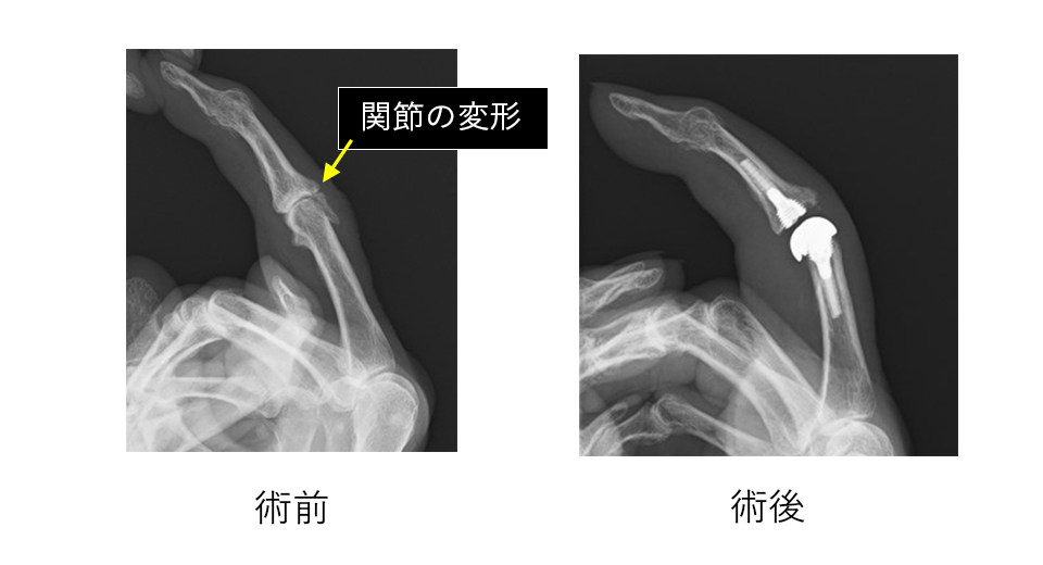 手指関節症に対する人工関節置換術