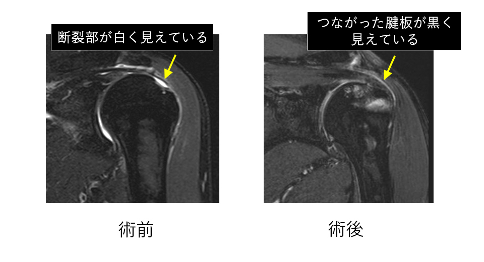 肩腱板損傷に対する肩関節鏡