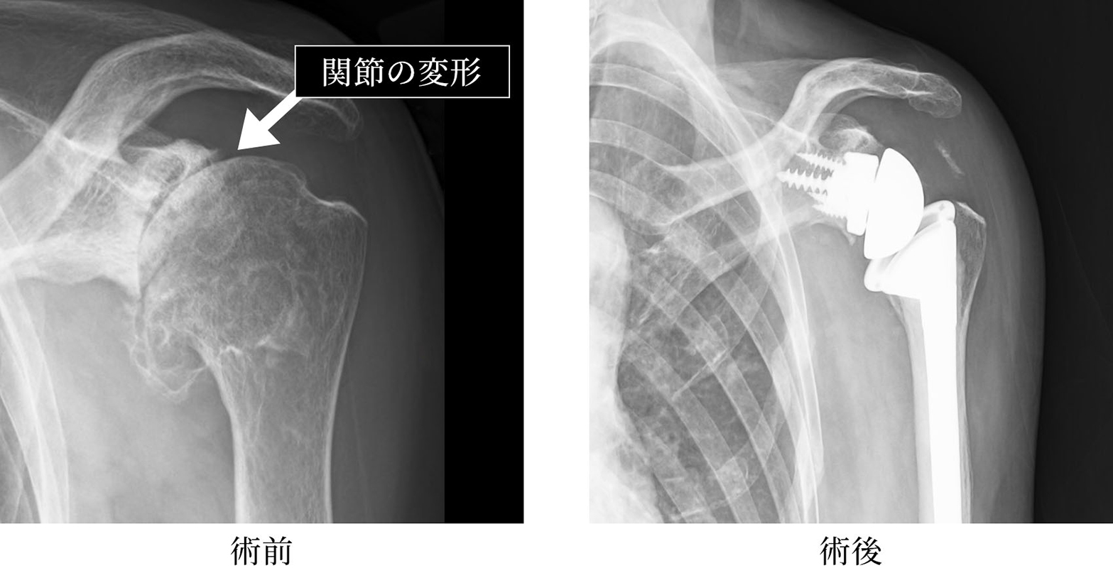 反転型肩人工関節置換術