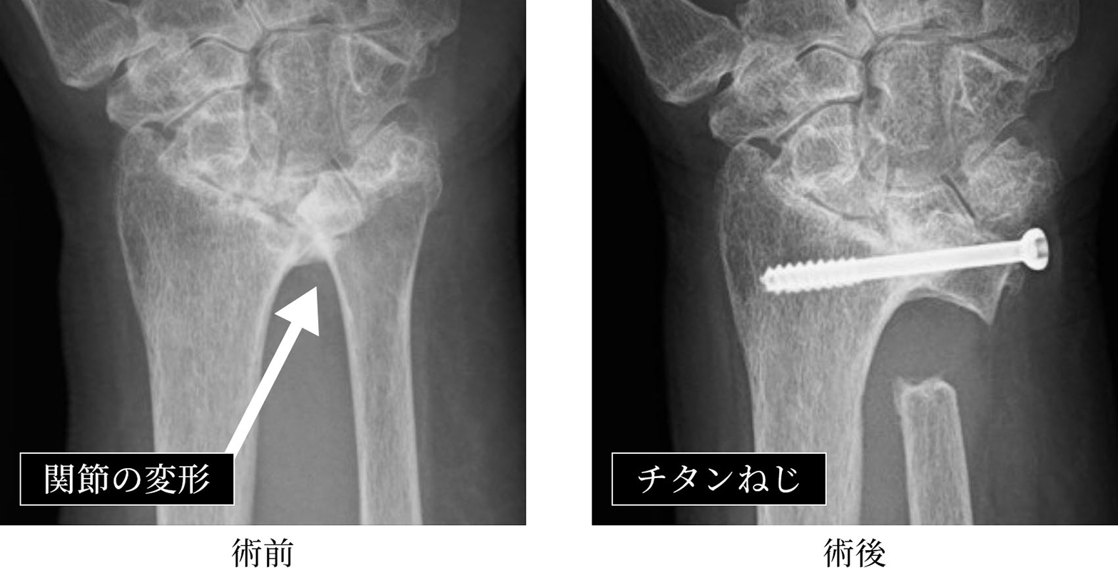 リウマチ関節形成術