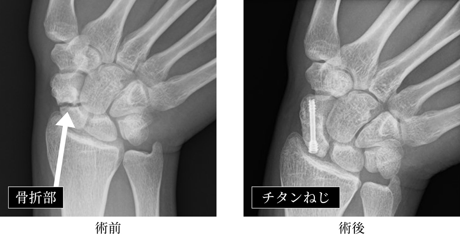 舟状骨偽関節